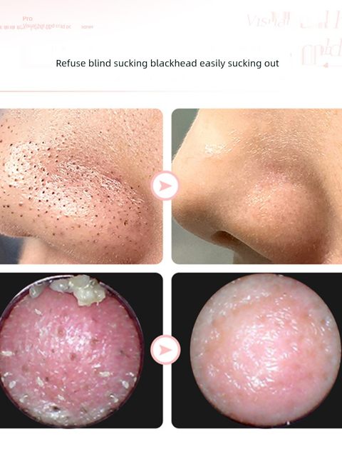 V.ONE wrist-sucking blackhead instrument face cleaning pore visualization electric artifact acne removal suction device