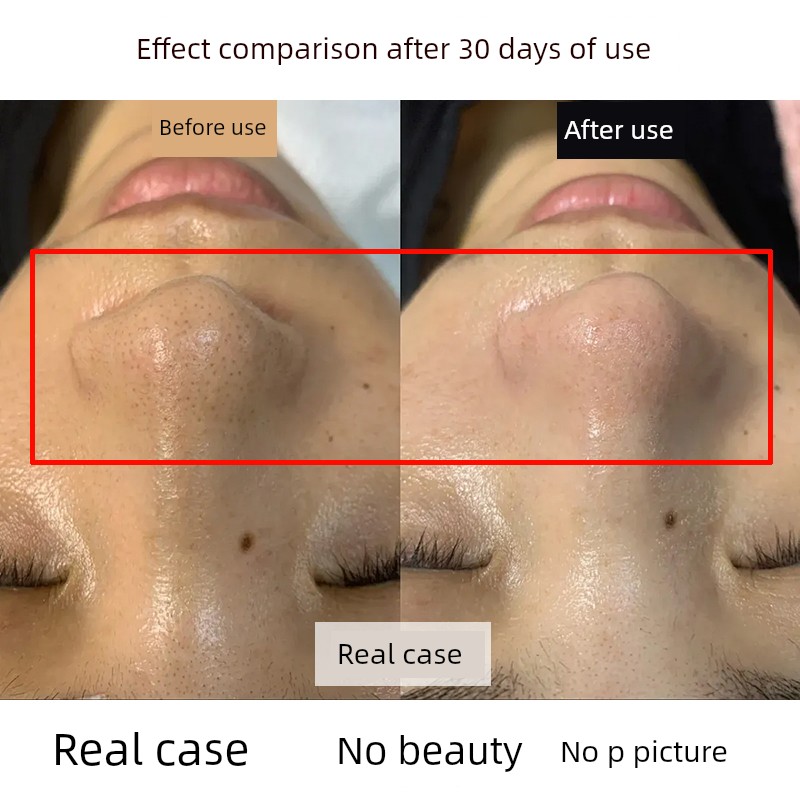 Hanji Tea Tree Blackhead Removal Kit Official Genuine Product for Pore Tightening and Deep Cleansing, Professional Salon Grade Xza68
