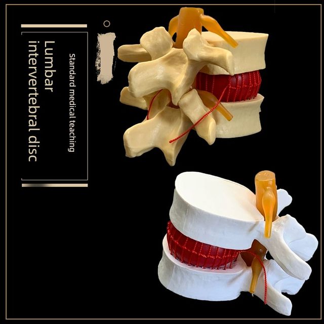 Medical human lumbar disc TU demonstration model Lumbar D lesion model Spine spine model Free shipping